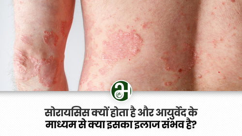 सोरायसिस क्यों होता है और आयुर्वेद के माध्यम से क्या इसका इलाज संभव है